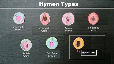 hymen pictures|Hymen